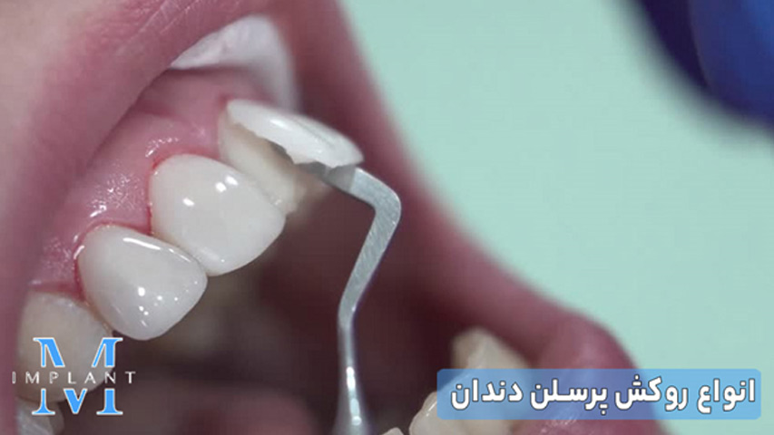 انواع روکش پرسلن دندان 