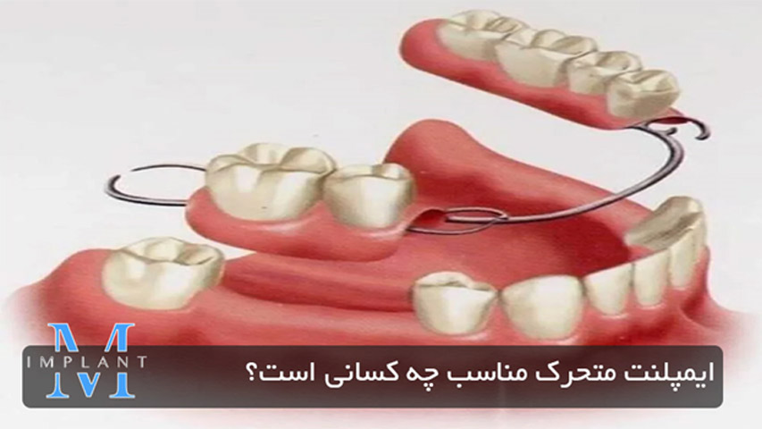 ایمپلنت متحرک مناسب چه کسانی هست؟