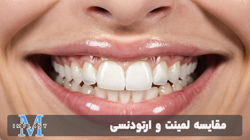 مقایسه لمینت و ارتودنسی