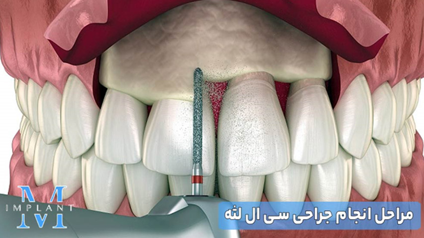 مراحل انجام جراحی سی ال لثه