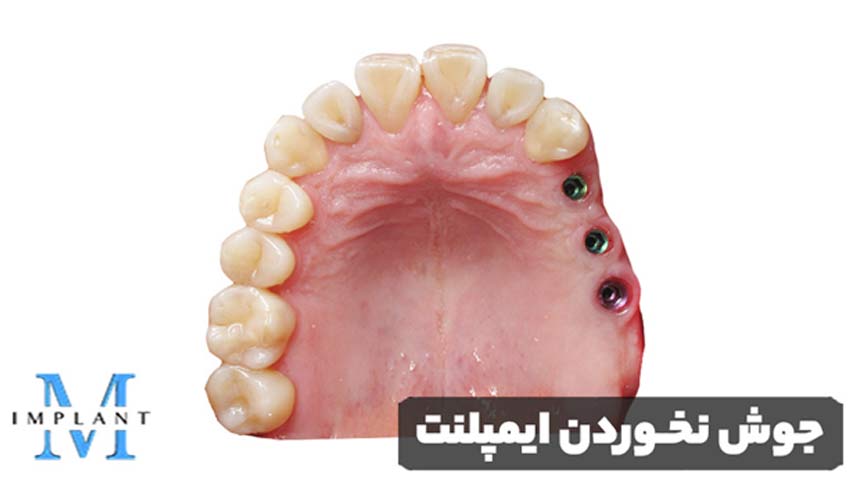 جوش نخوردن ایمپلنت