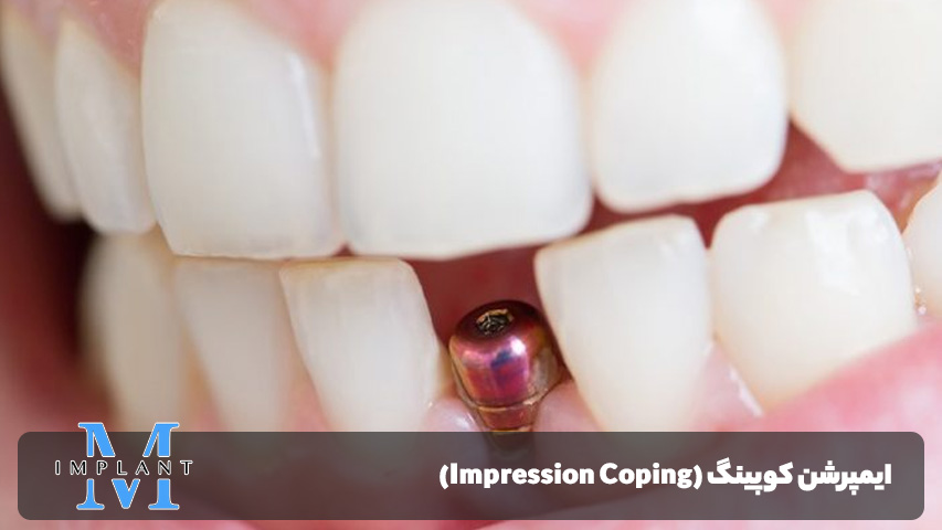 ایمپرشن کوپینگ (Impression Coping)