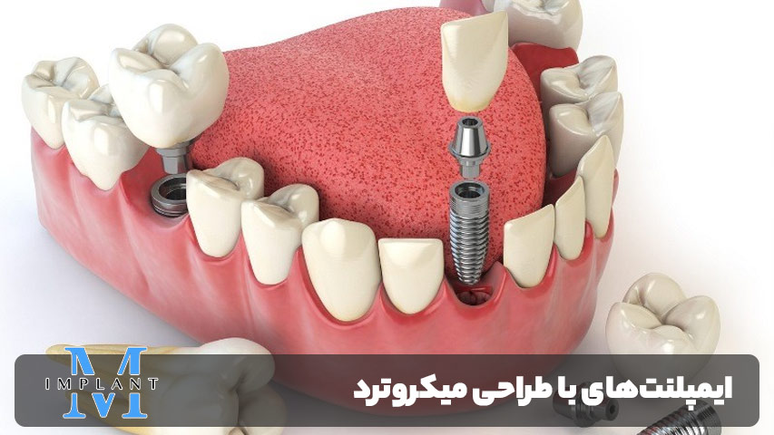 ایمپلنت‌های با طراحی میکروترد