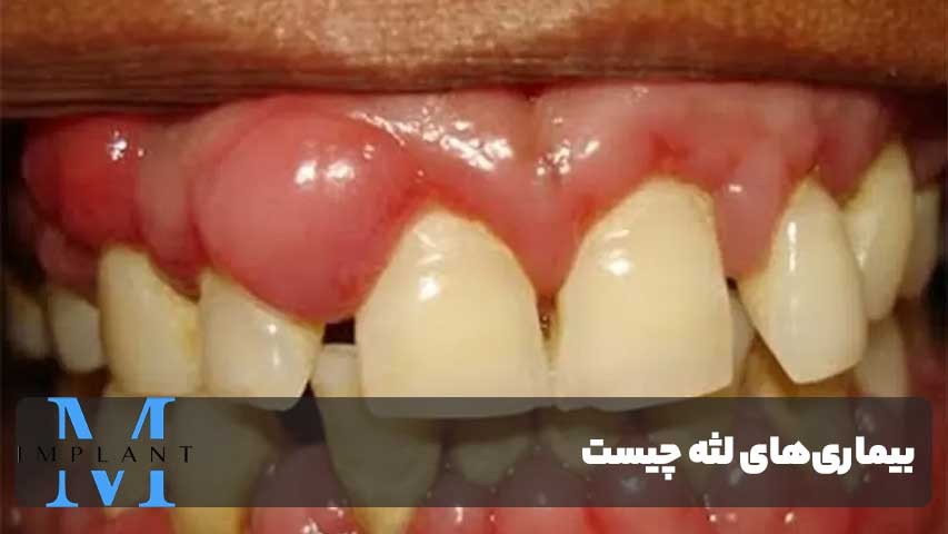 تاثیر بیماری‌های لثه بر سلامت عمومی