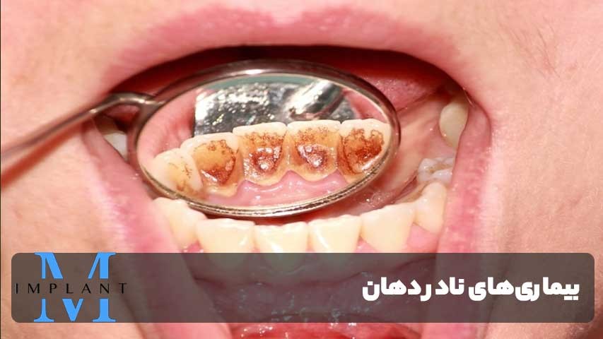 بیماری‌های نادر دهان