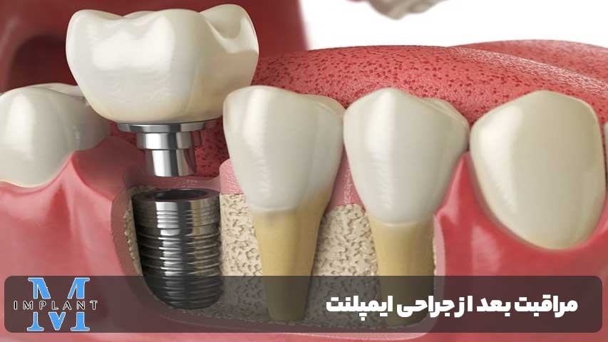مراقبت بعد از جراحی ایمپلنت