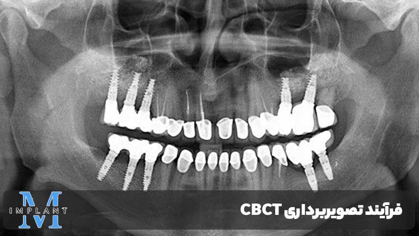 زمان آماده شدن CBCT
