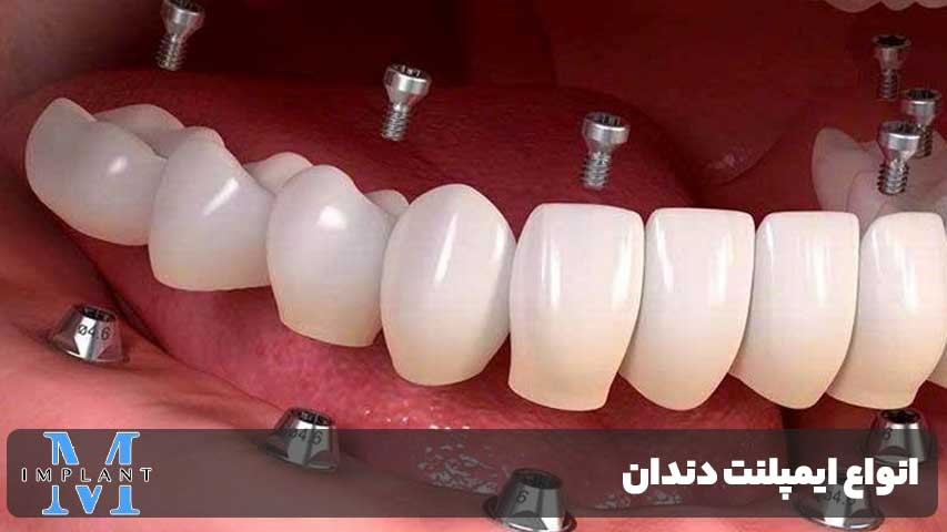 انواع ایمپلنت دندان