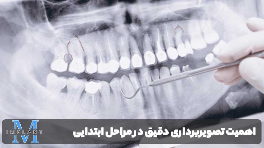 تشخیص پیش از ایمپلنت