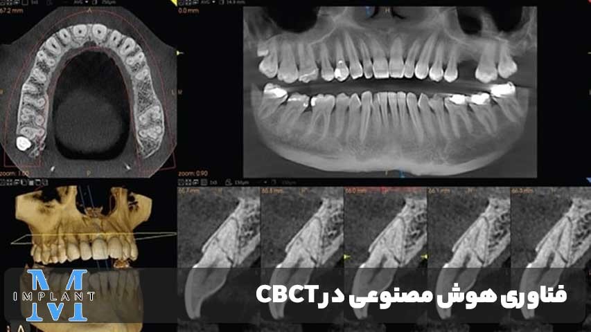 هوش مصنوعی در CBCT