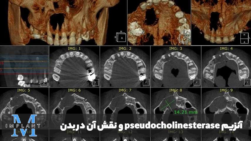بی‌حسی بیماران pseudocholinesterase