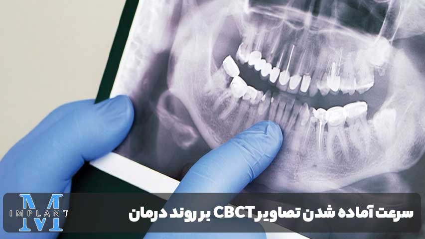 تاثیر سرعت آماده شدن تصاویر CBCT بر روند درمان