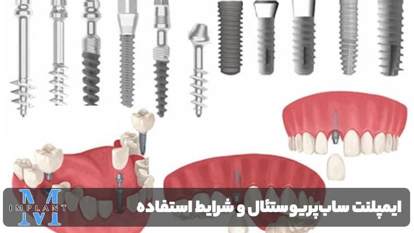 ایمپلنت ساب‌پریوستئال و شرایط استفاده