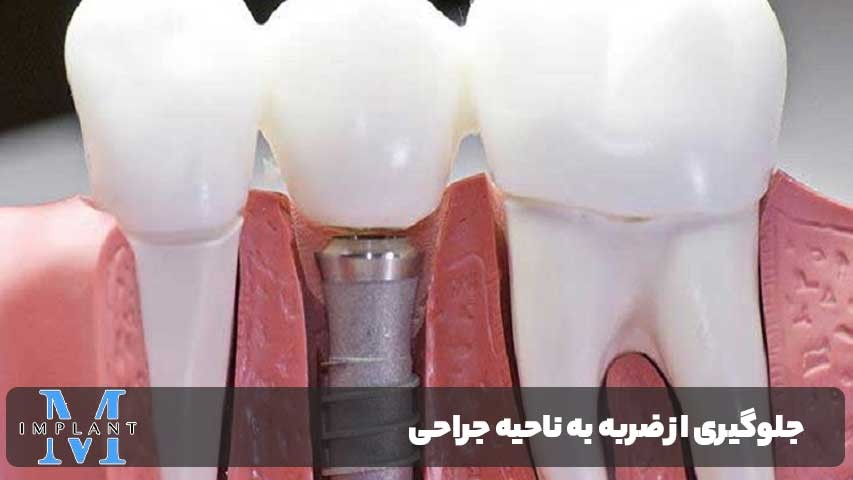 چگونه از فشار و ضربه به ناحیه جراحی جلوگیری کنیم؟